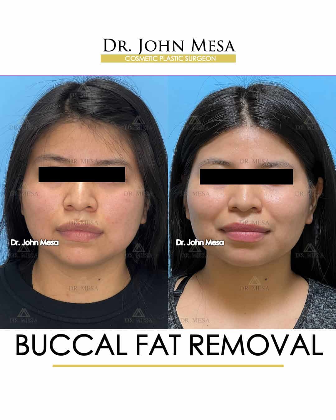 Best Buccal Fat Removal Doctor