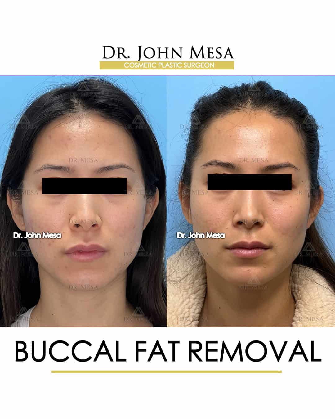 Buccal Fat Removal Before and After Photos