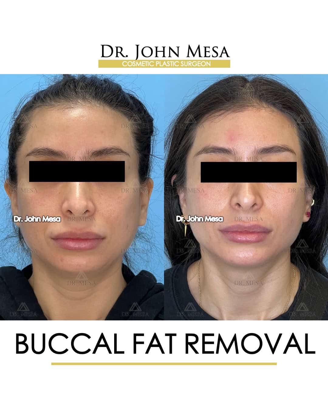 best buccal fat removal doctor near me