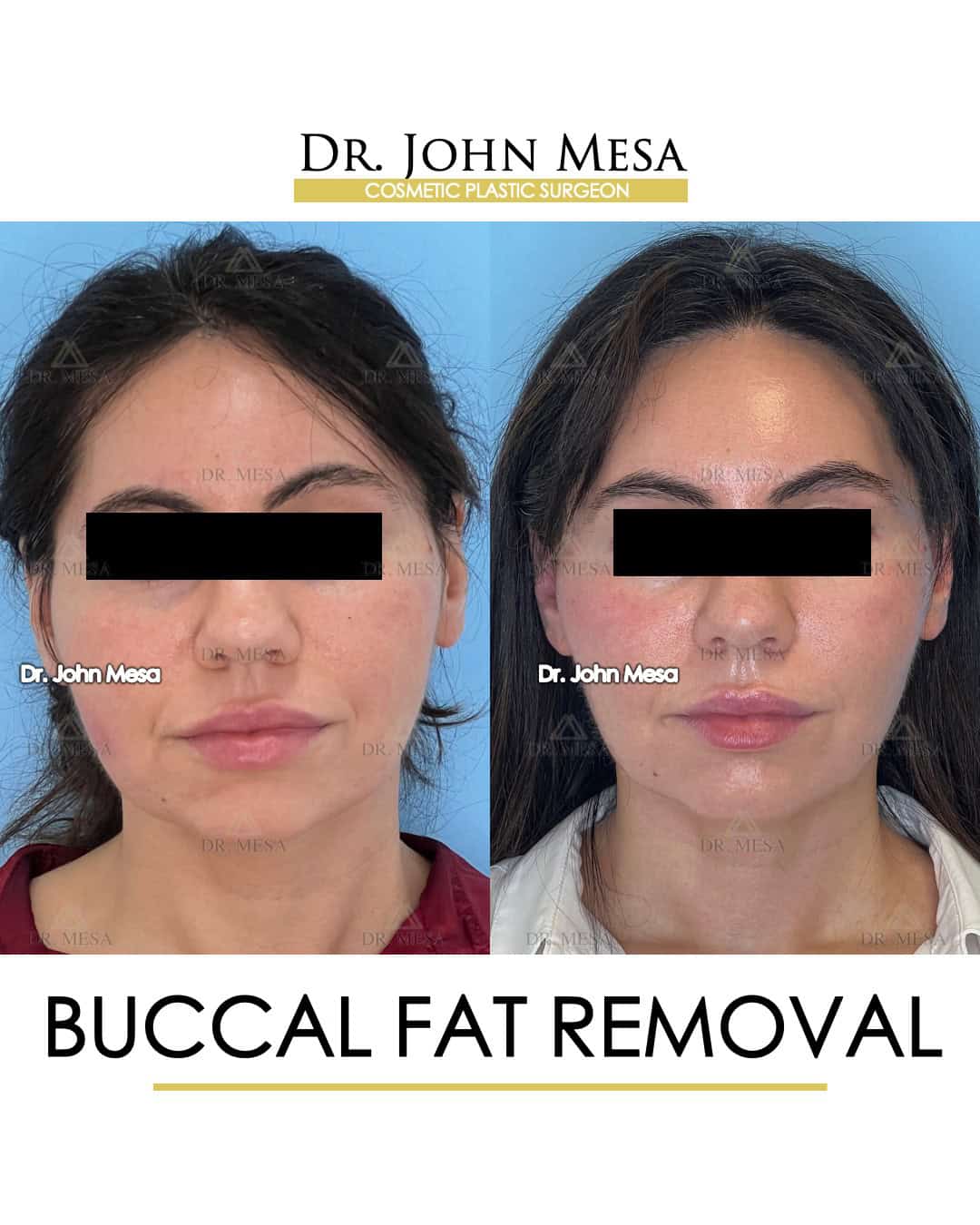 buccal fat removal nyc