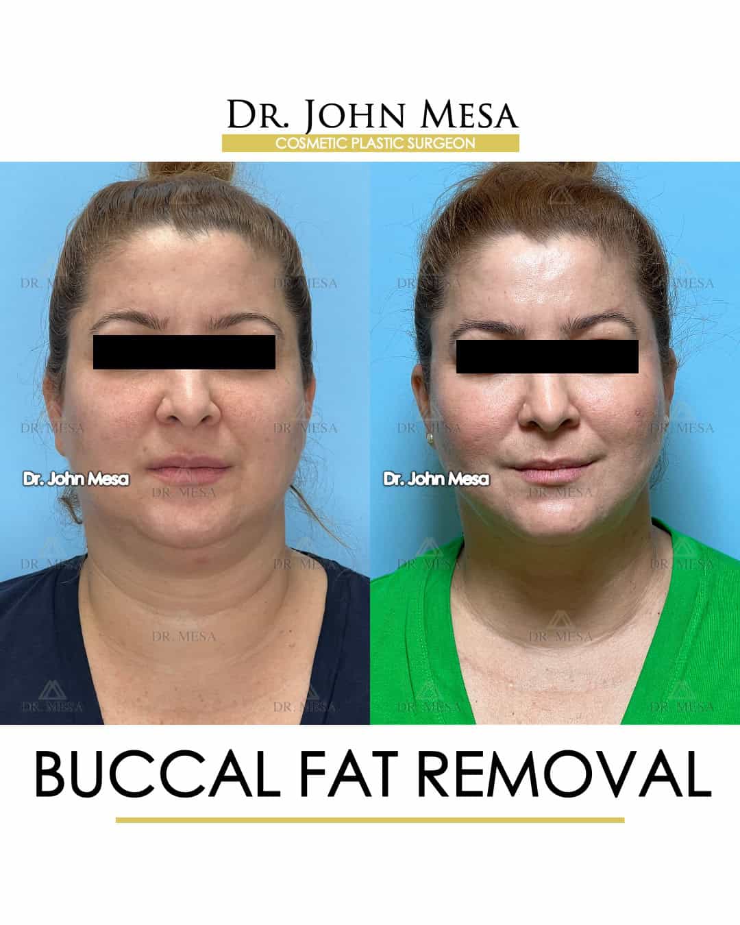 best buccal fat removal nyc
