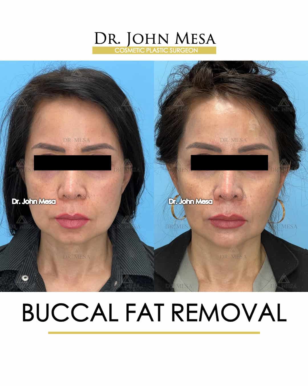 Buccal Fat Removal New York City