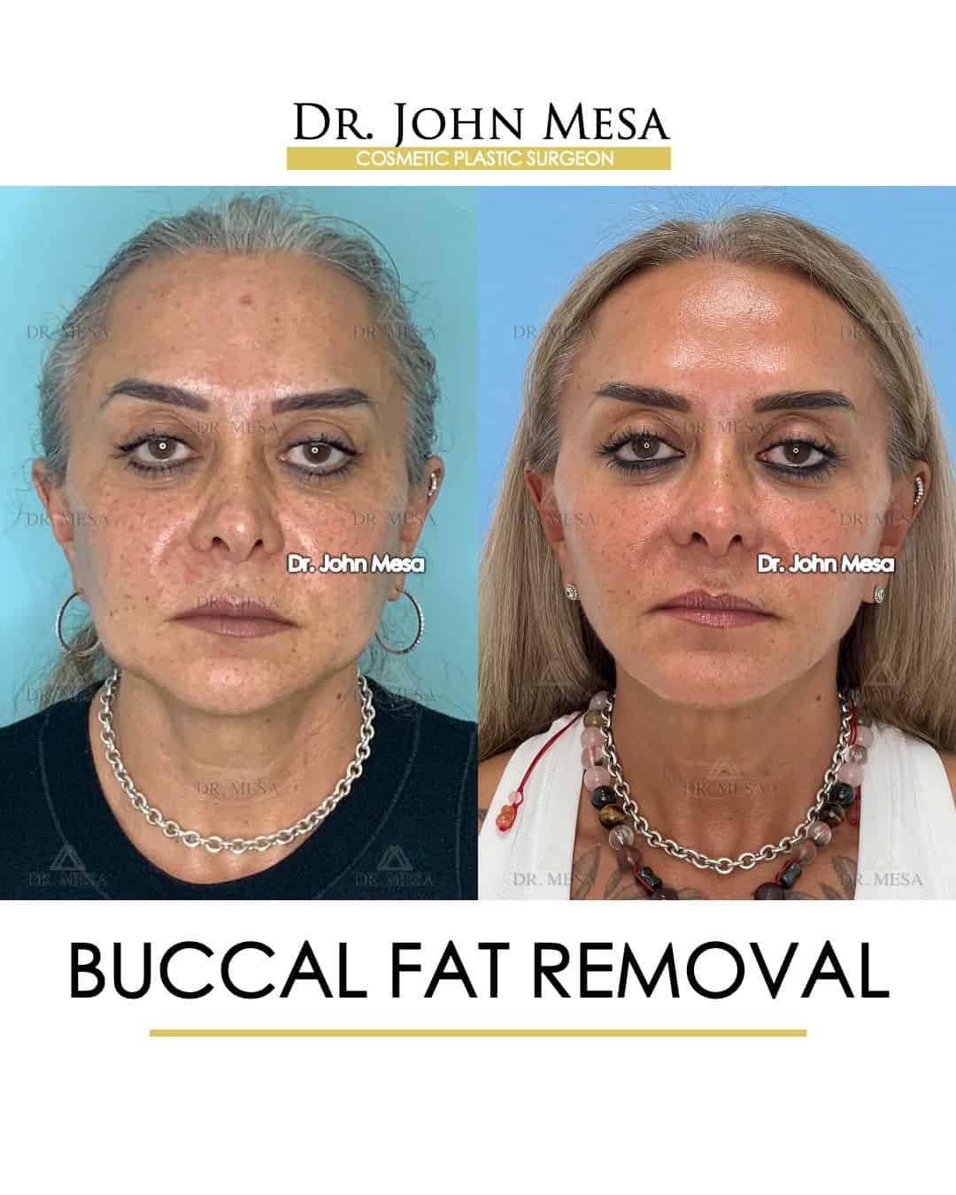 Buccal Fat Removal New York City