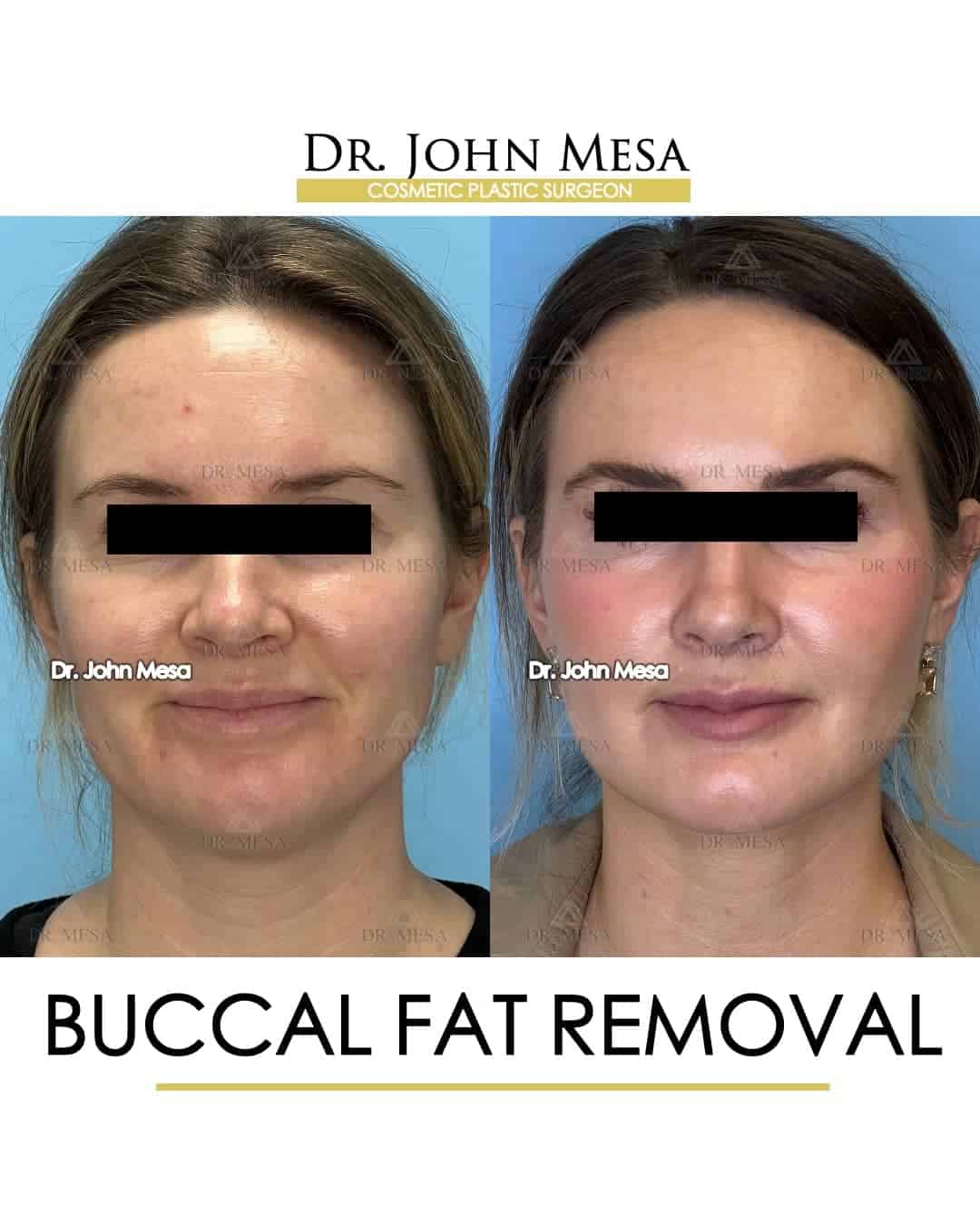 Buccal Fat Removal Before After