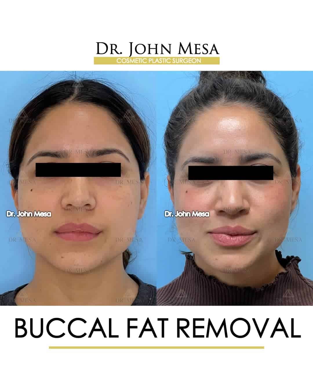 before and after buccal fat removal for women