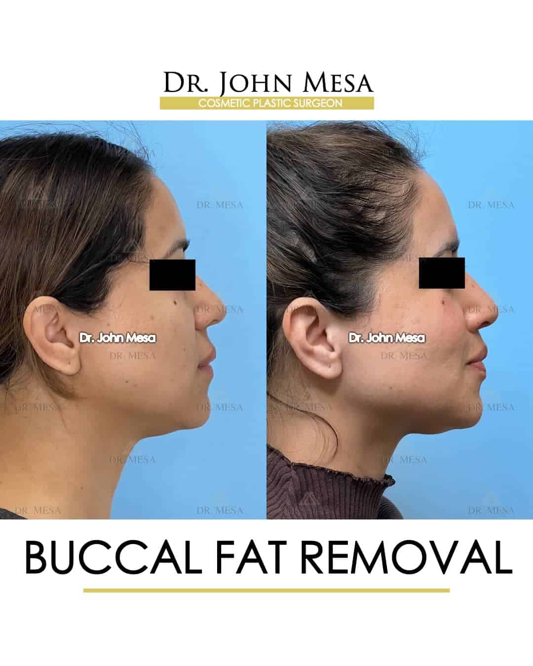 doctor for buccal fat removal nyc