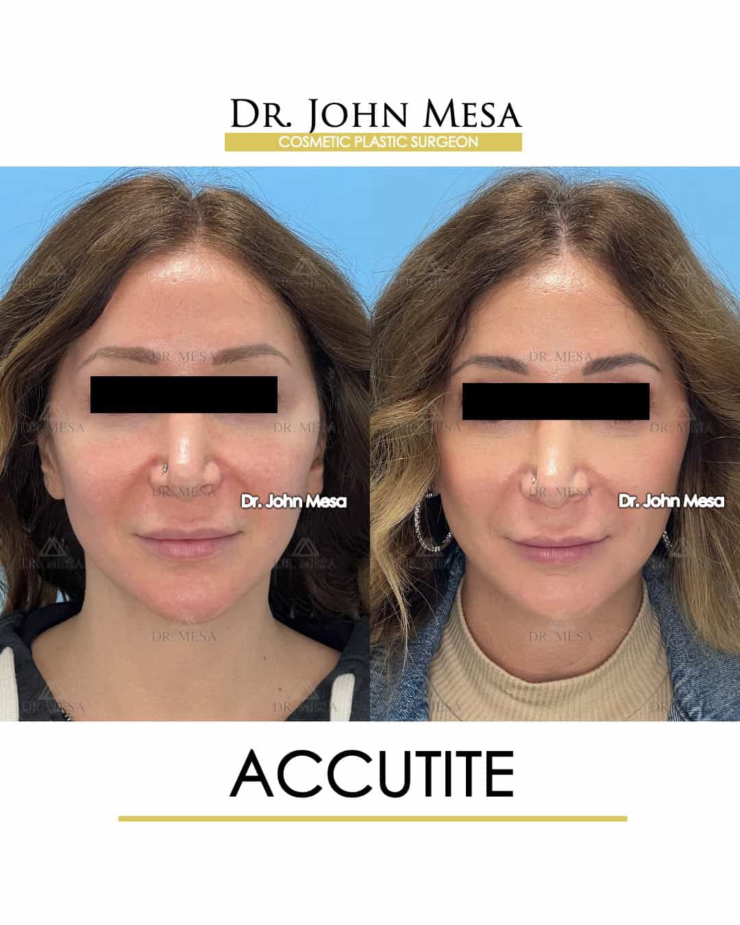 Otoplasty NYC