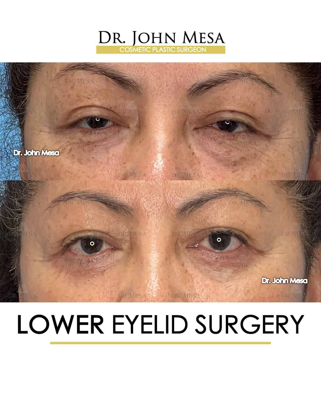 Lower Eyelid Surgery NYC Doctor