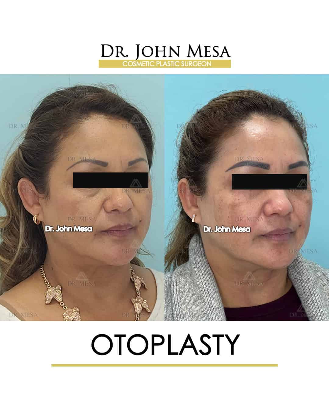 Otoplasty NYC