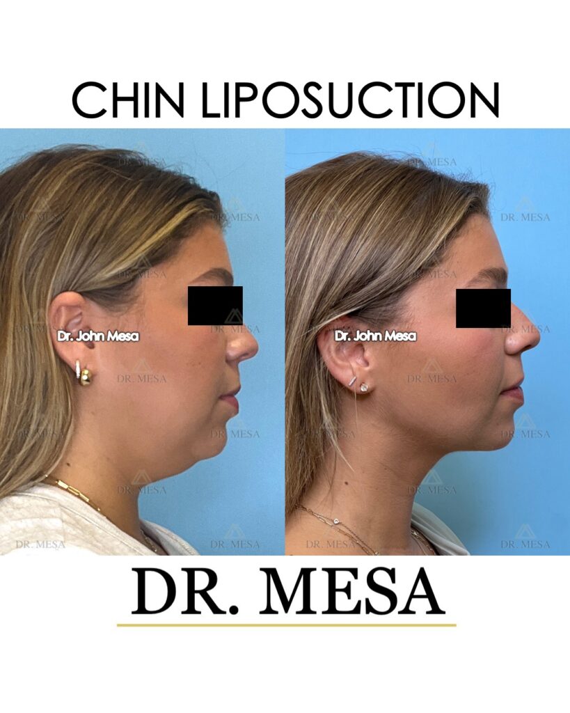 Chin-Liposuction-24yoF- 004
