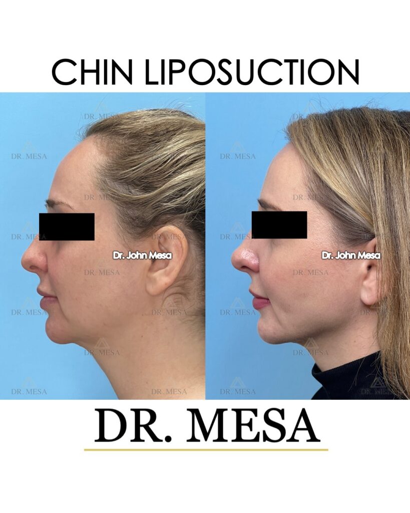 Chin-Liposuction-35yoF- 006