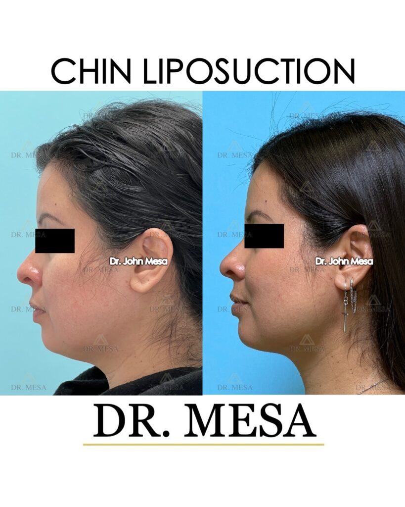 Chin-Liposuction-36yoF- 017
