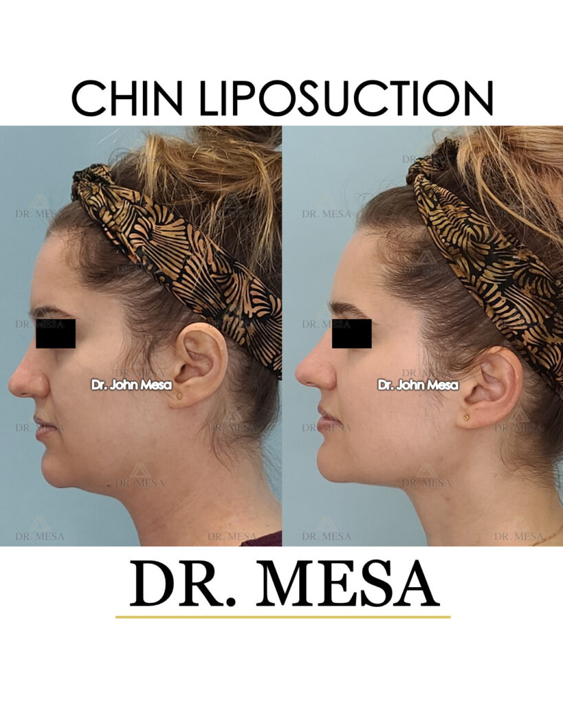 ChinLipo-32yoF-005