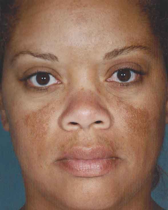 does obagi nu derm work for women