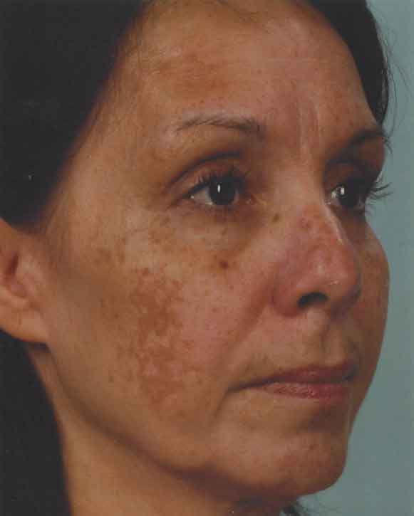 obagi nu derm system