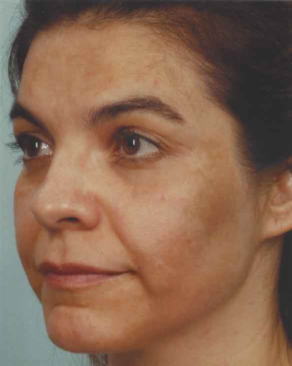 how does obagi nu derm work