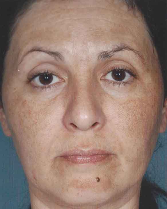 does obagi nu derm really work