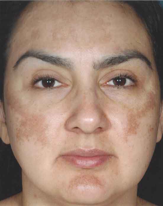 obagi nu derm before and after