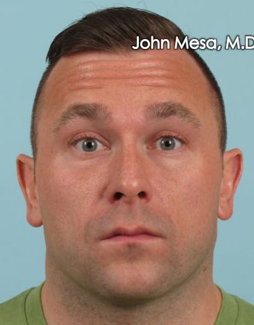 before and after photos of botox