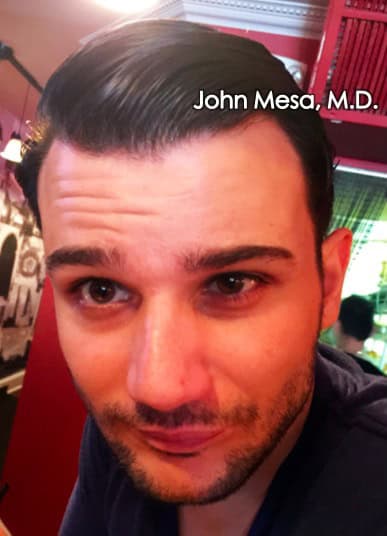 chipmunk cheeks botox for men before and after photos