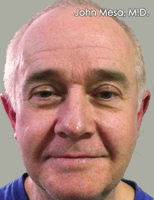 chipmunk cheeks after botox