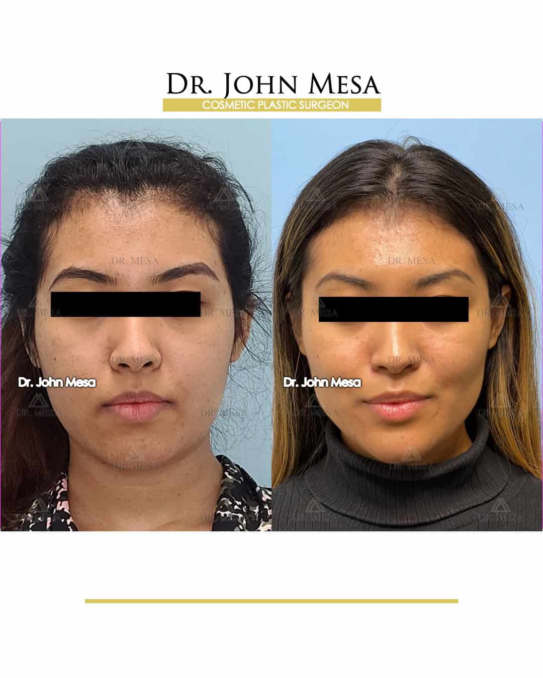 cheekbone-filler-cost-in-miami