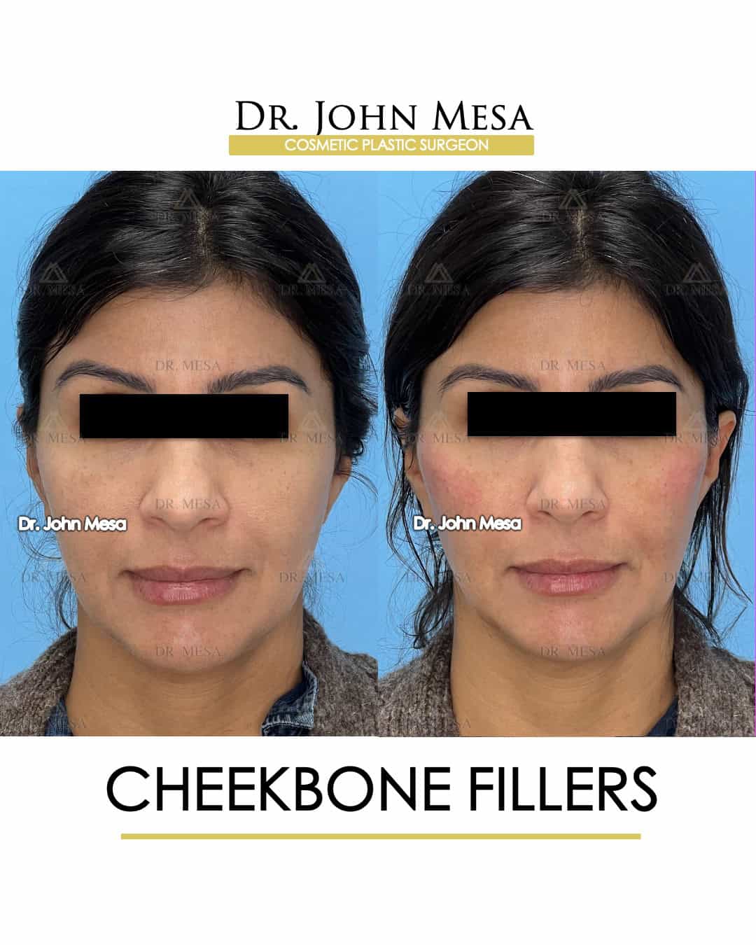 how-long-do-cheekbone-filler-last