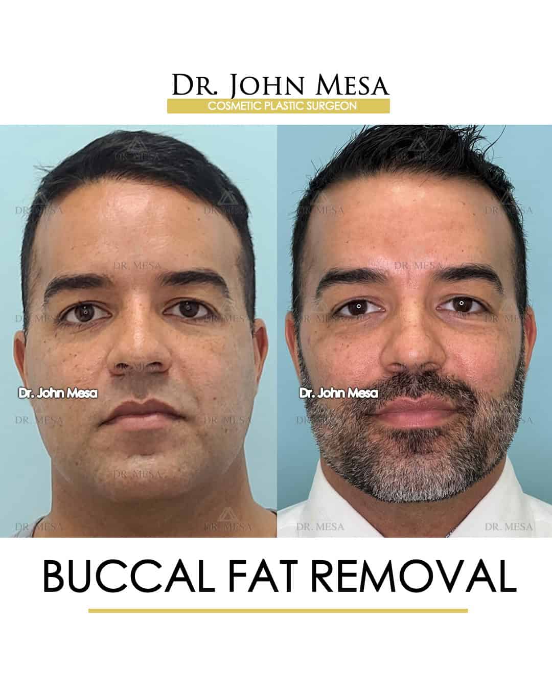 buccal fat removal surgery before and after surgery results