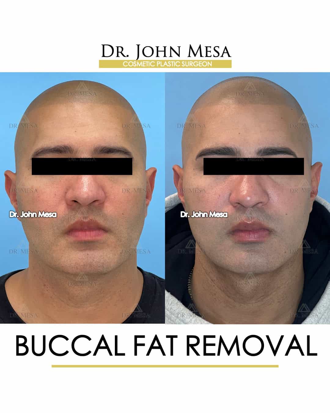 buccal fat removal 10 years later