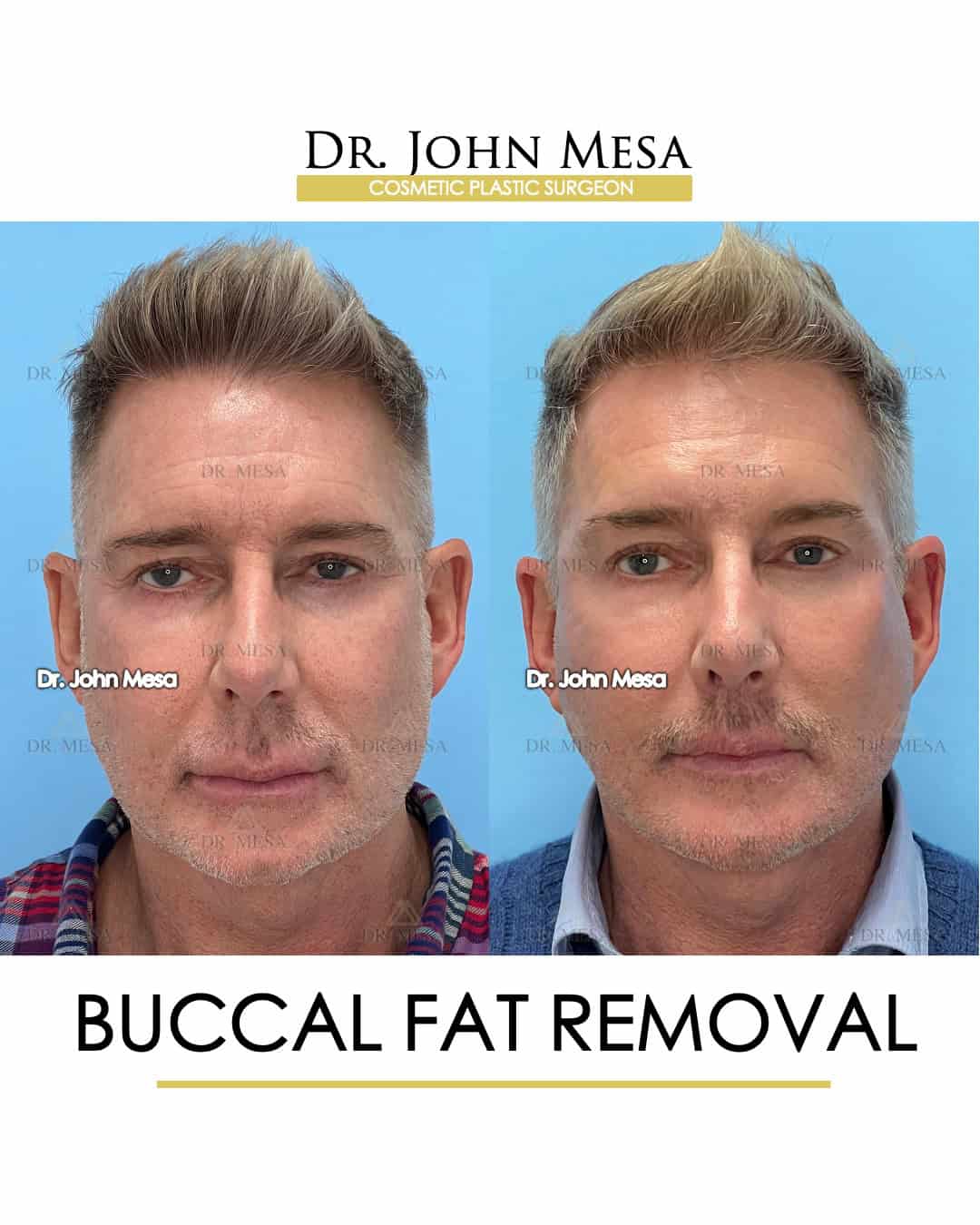 before and after buccal fat removal male celebrity