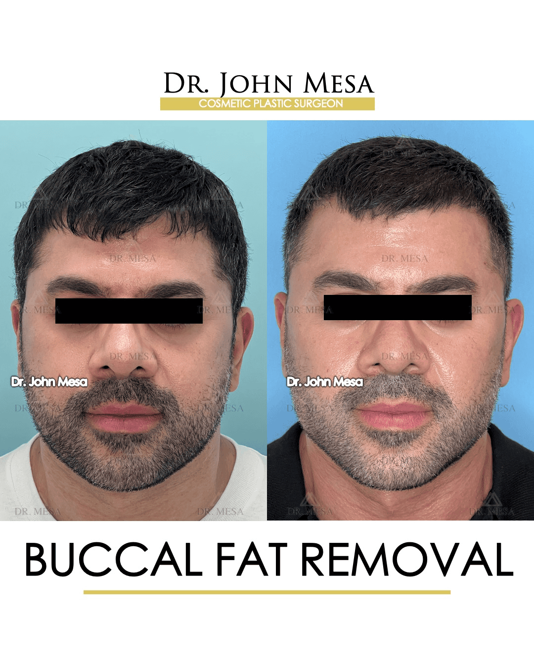 buccal fat removal after 10 years results
