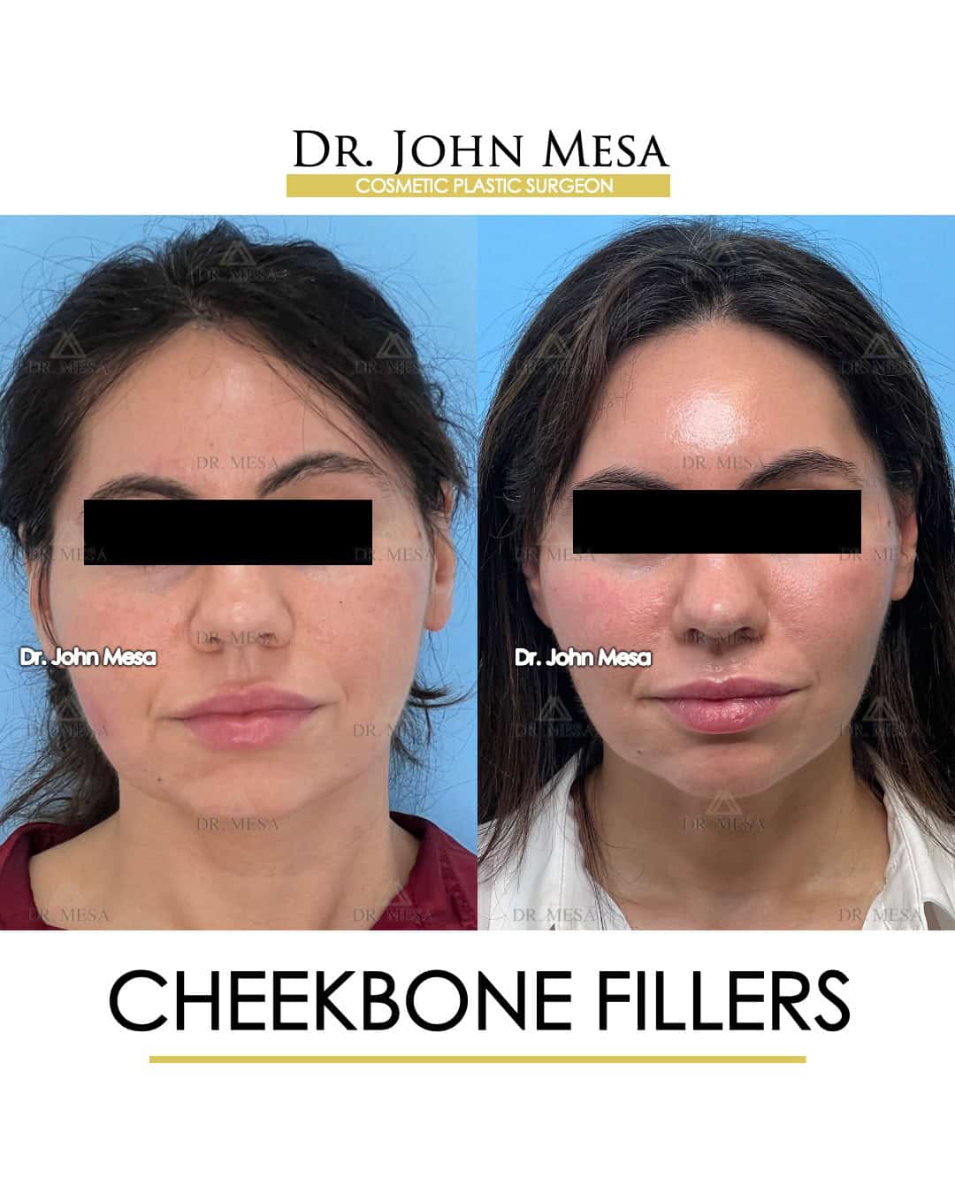 cheekbone-filler-near-me