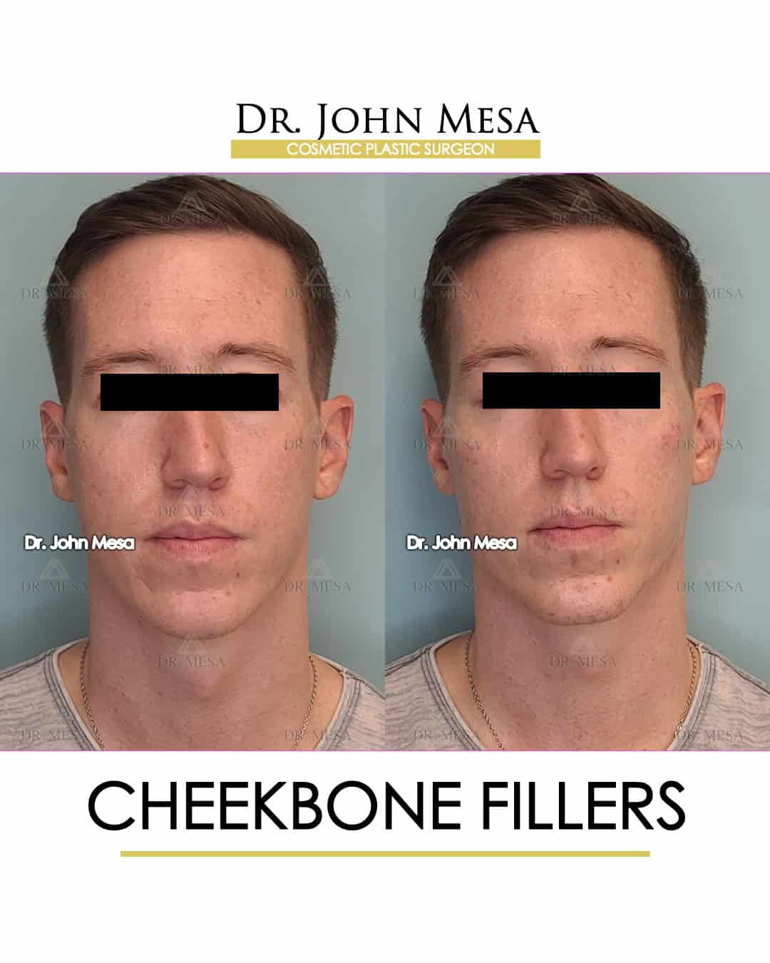 Fillers for cheekbones
