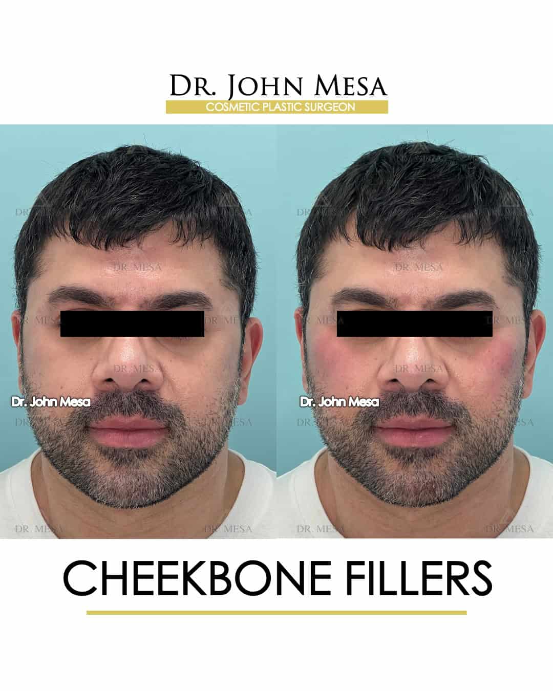 Cheekbone Fillers Before and After