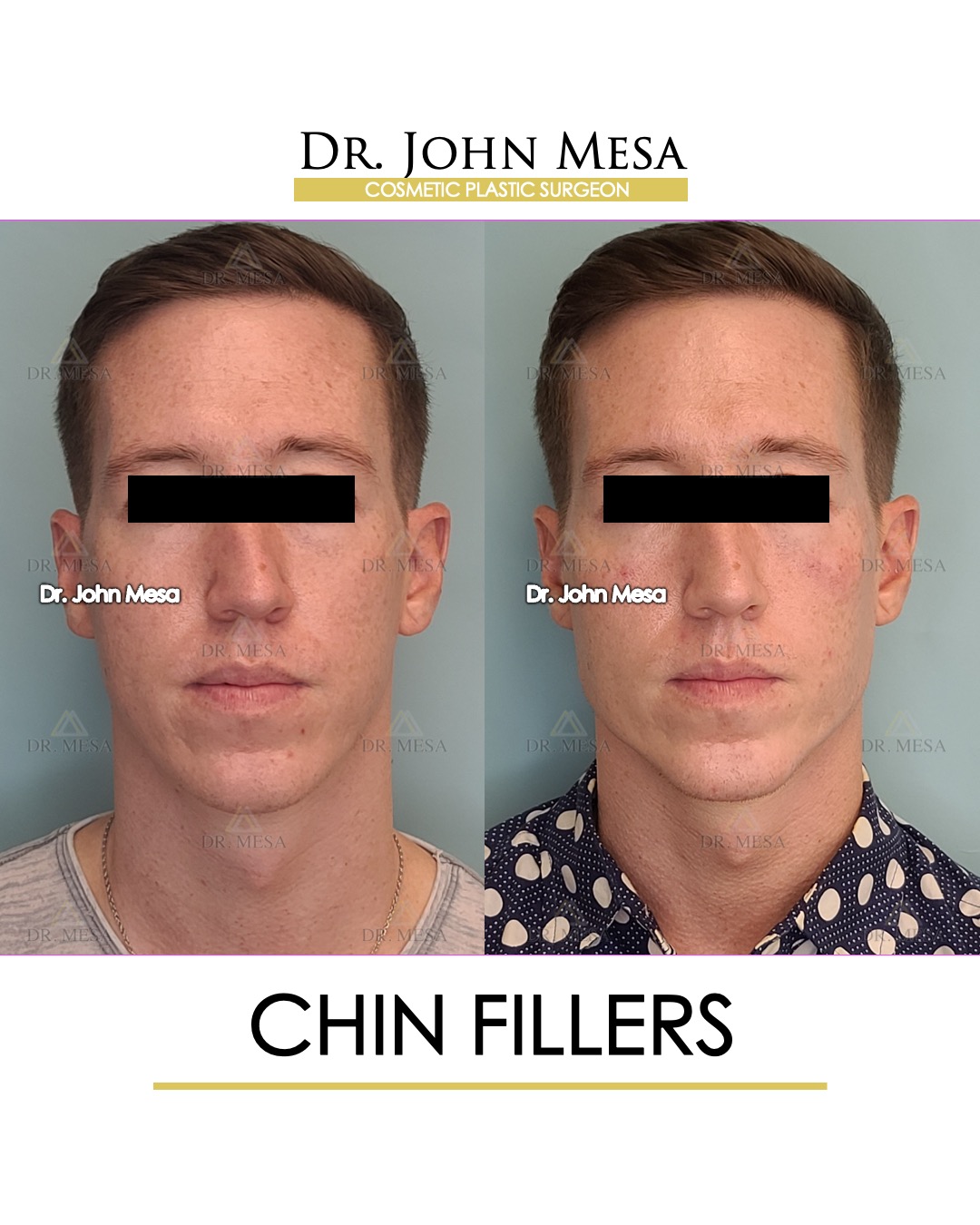 chin filler for men nyc
