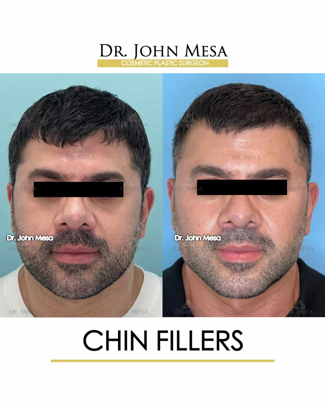 chin filler nyc before and after