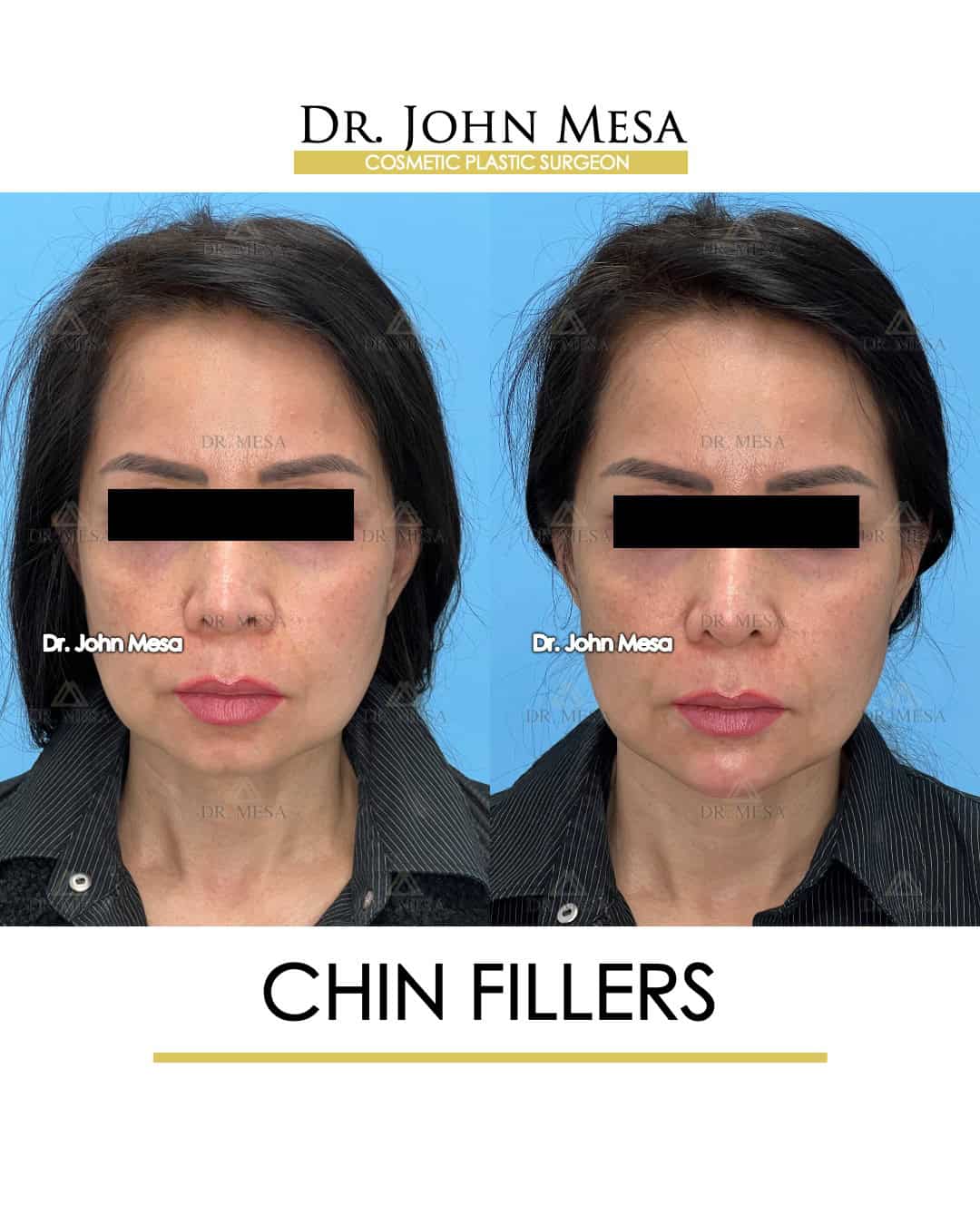 are chin fillers safe