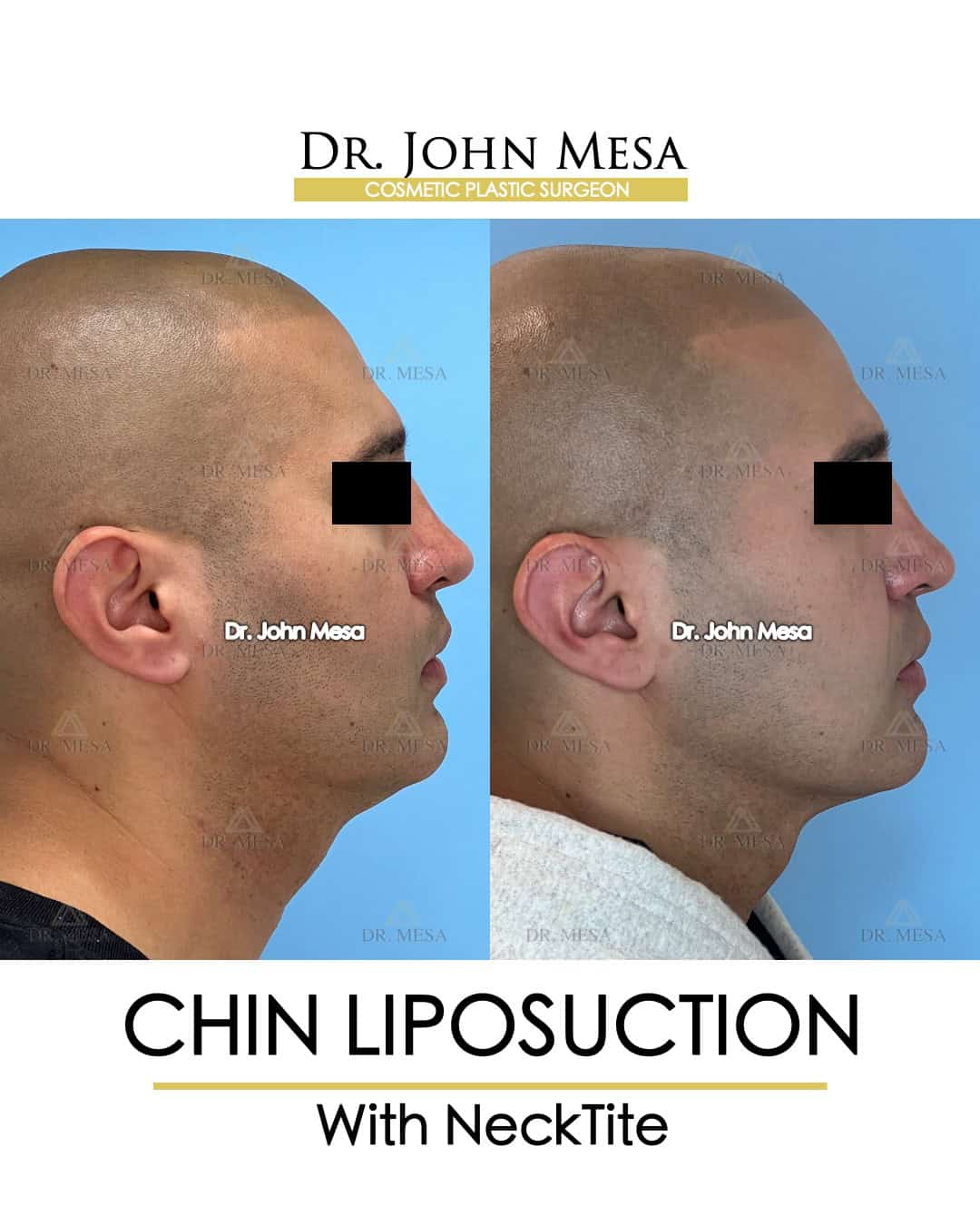 chin liposuction recovery photos