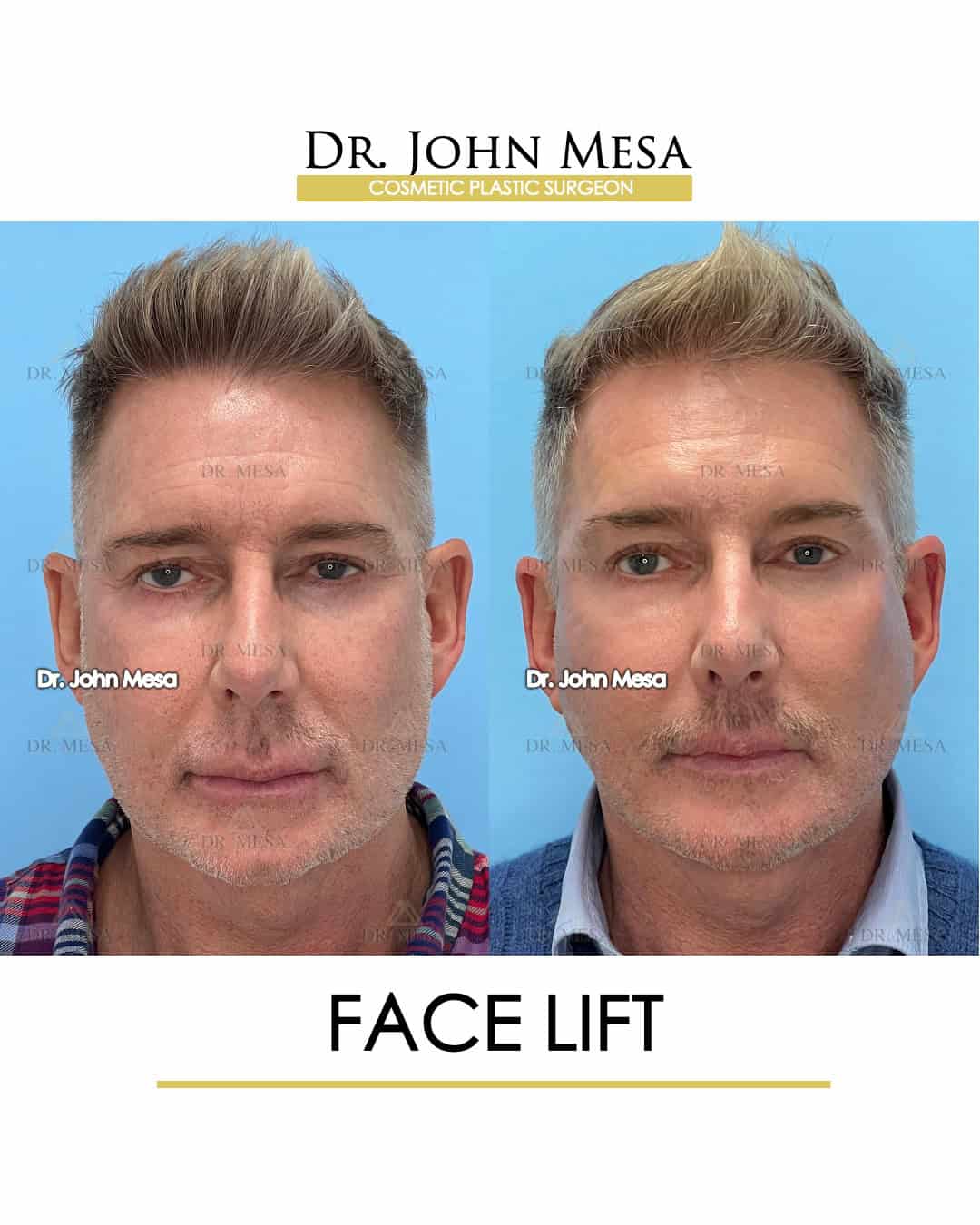 face lift before after pictures
