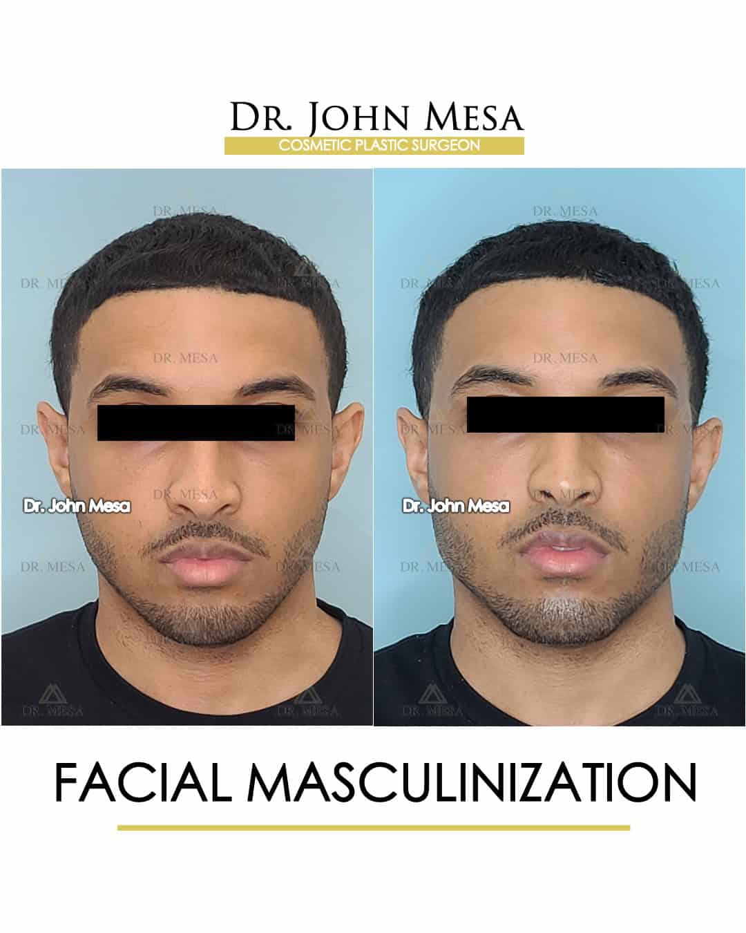 facial masculinization after surgery