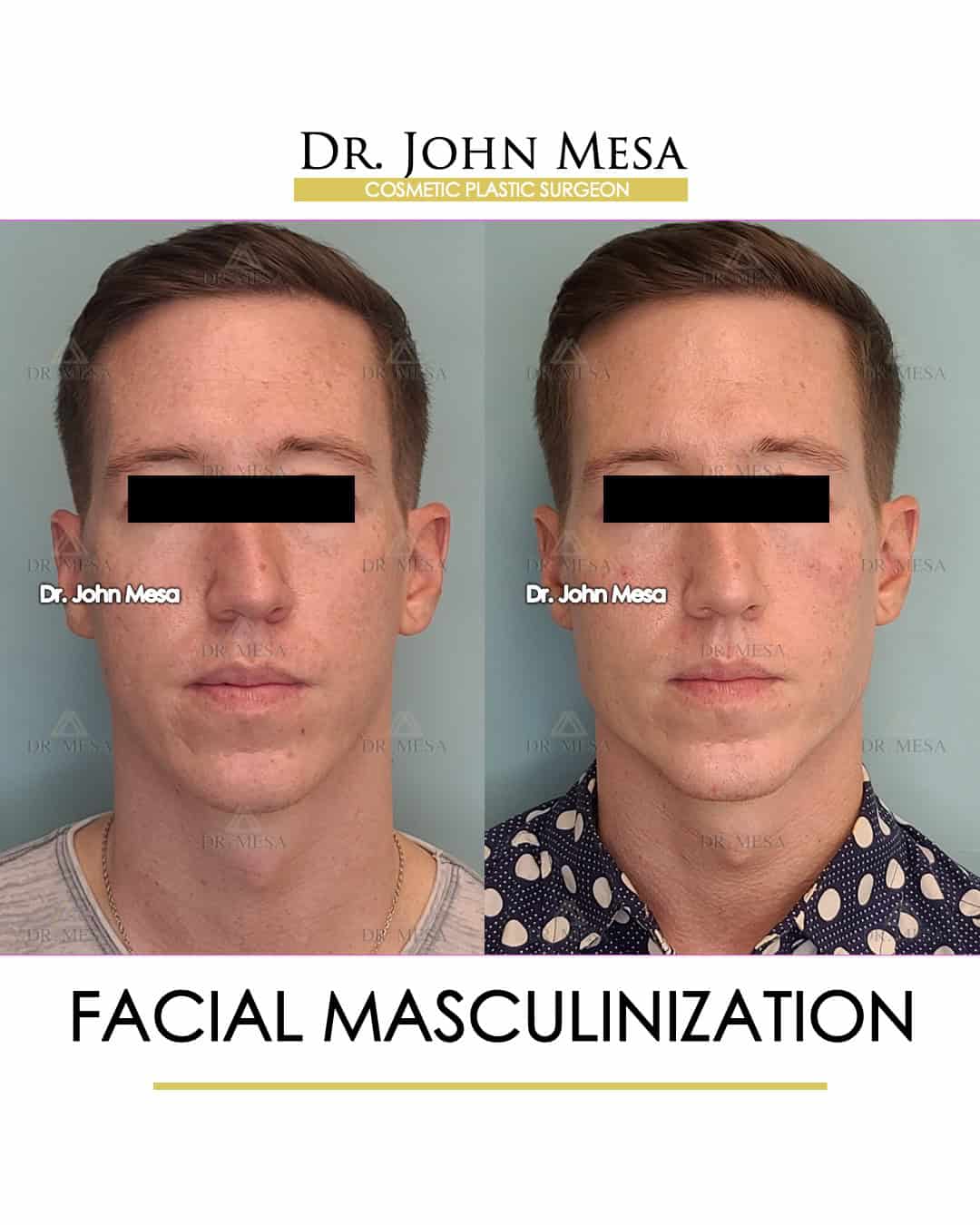 how much is facial masculinization surgery