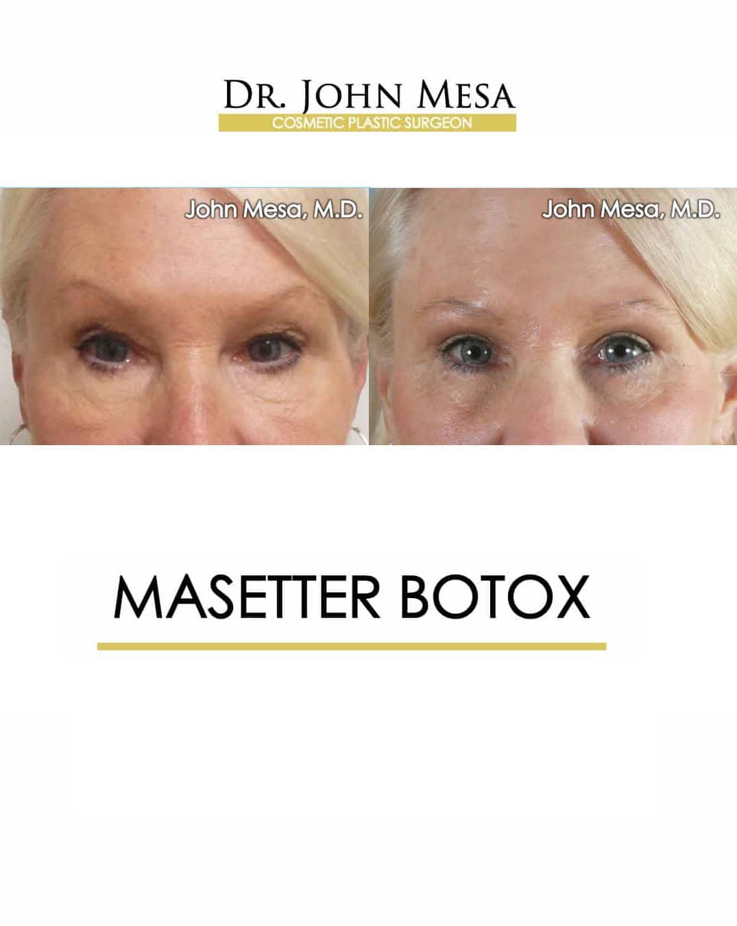 Masetter Botox NYC