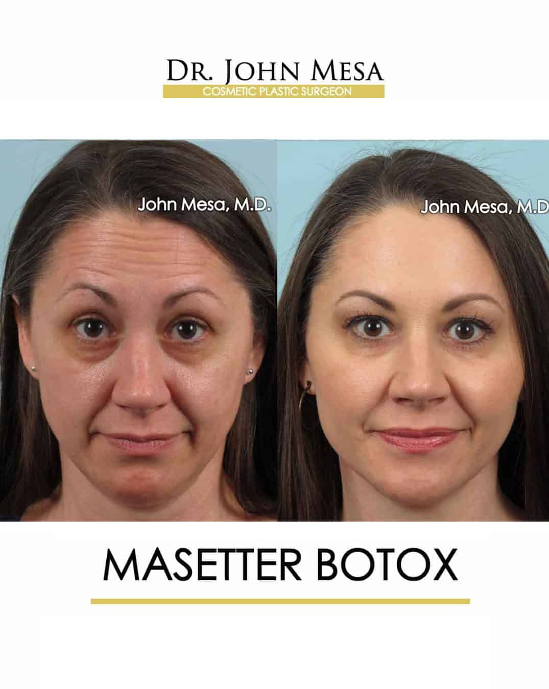 Masetter Botox NYC