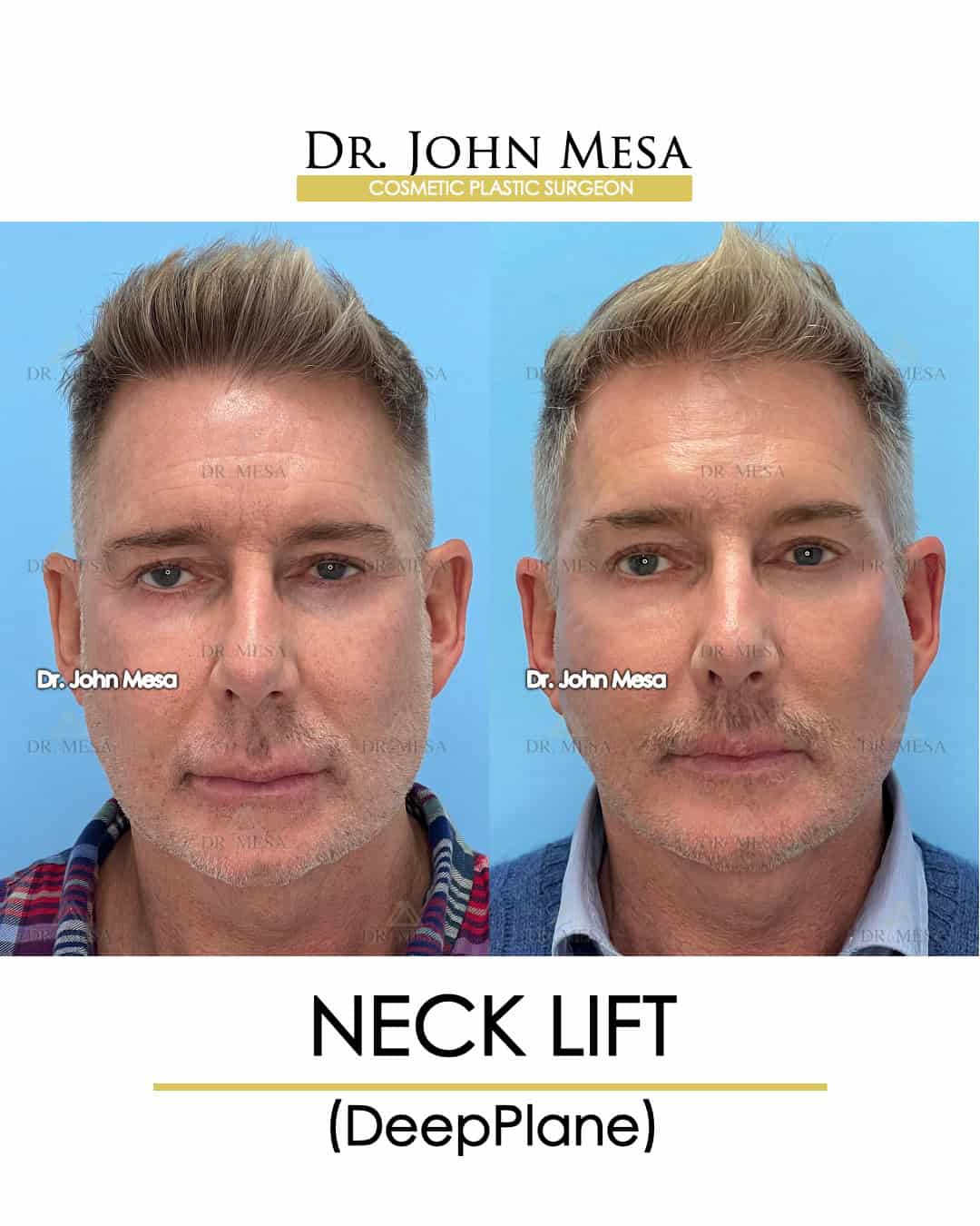 male celebrity neck lift before and after