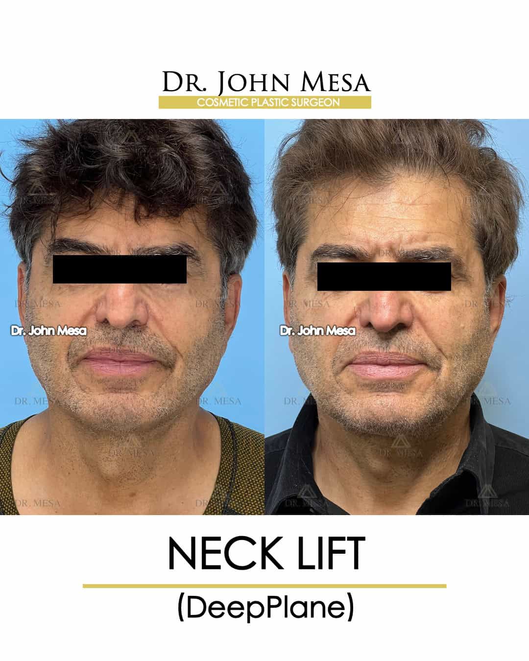 Mens neck lift