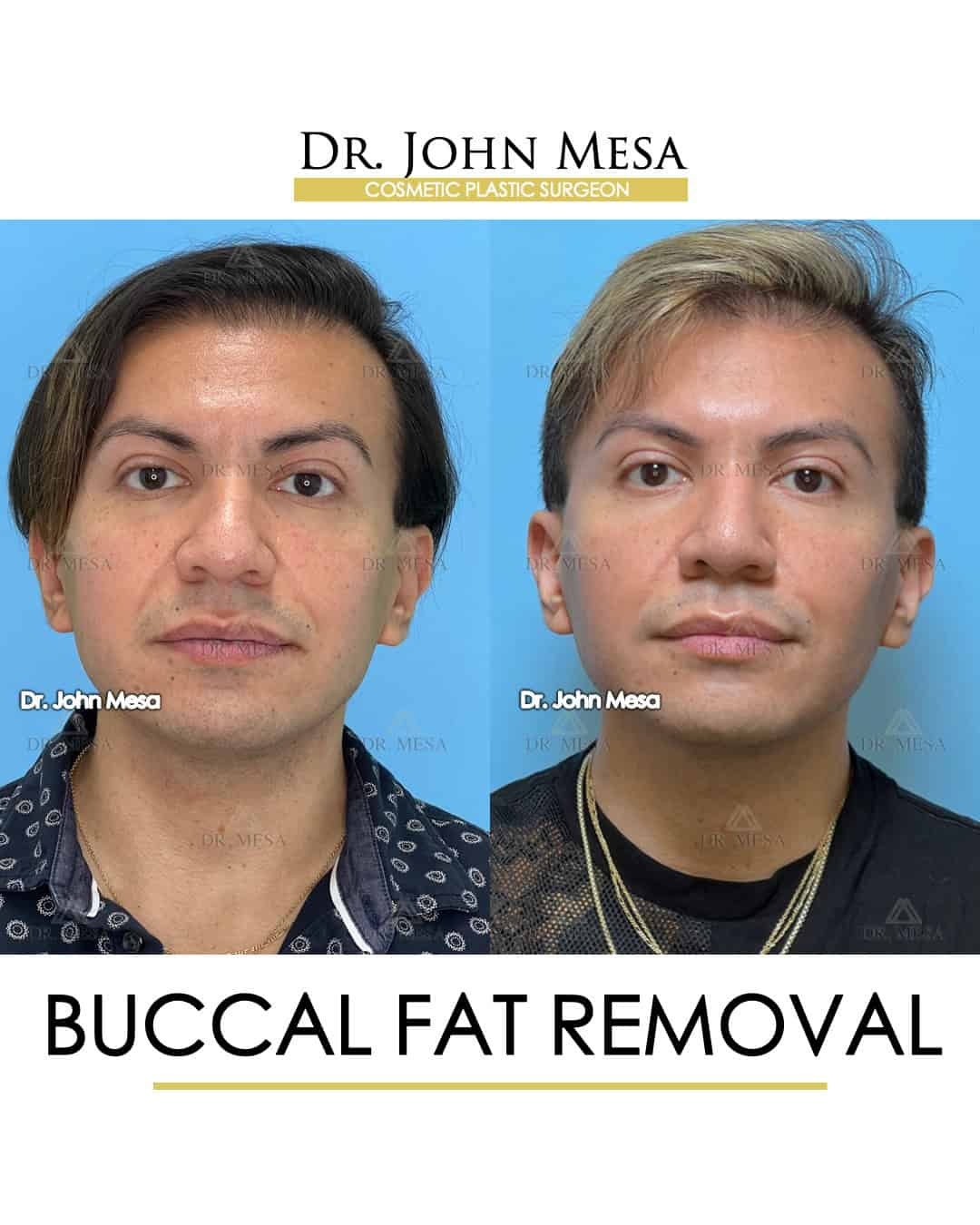 buccal fat removal before and after in ageing men