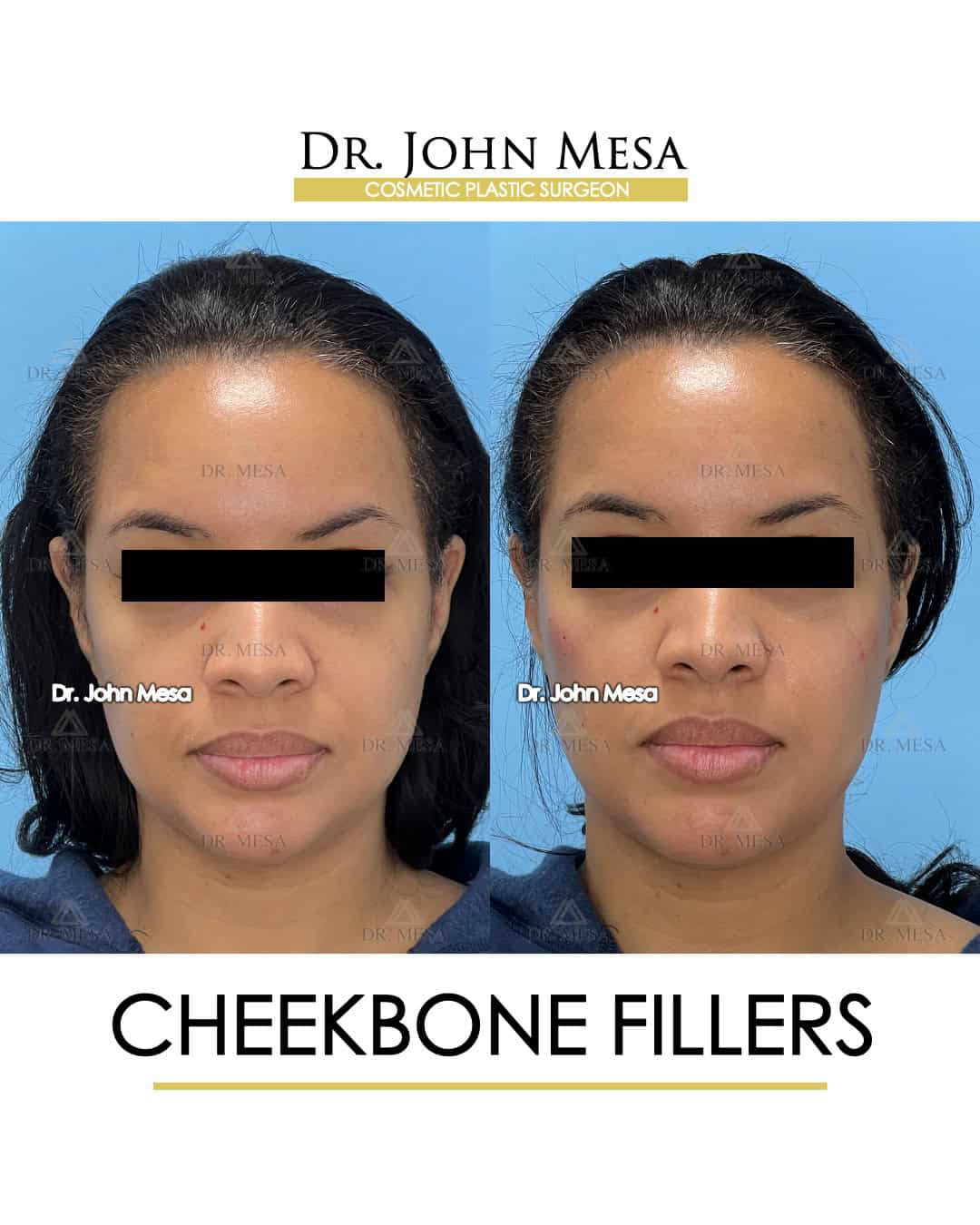 can-fillers-give-women-high-cheekbones