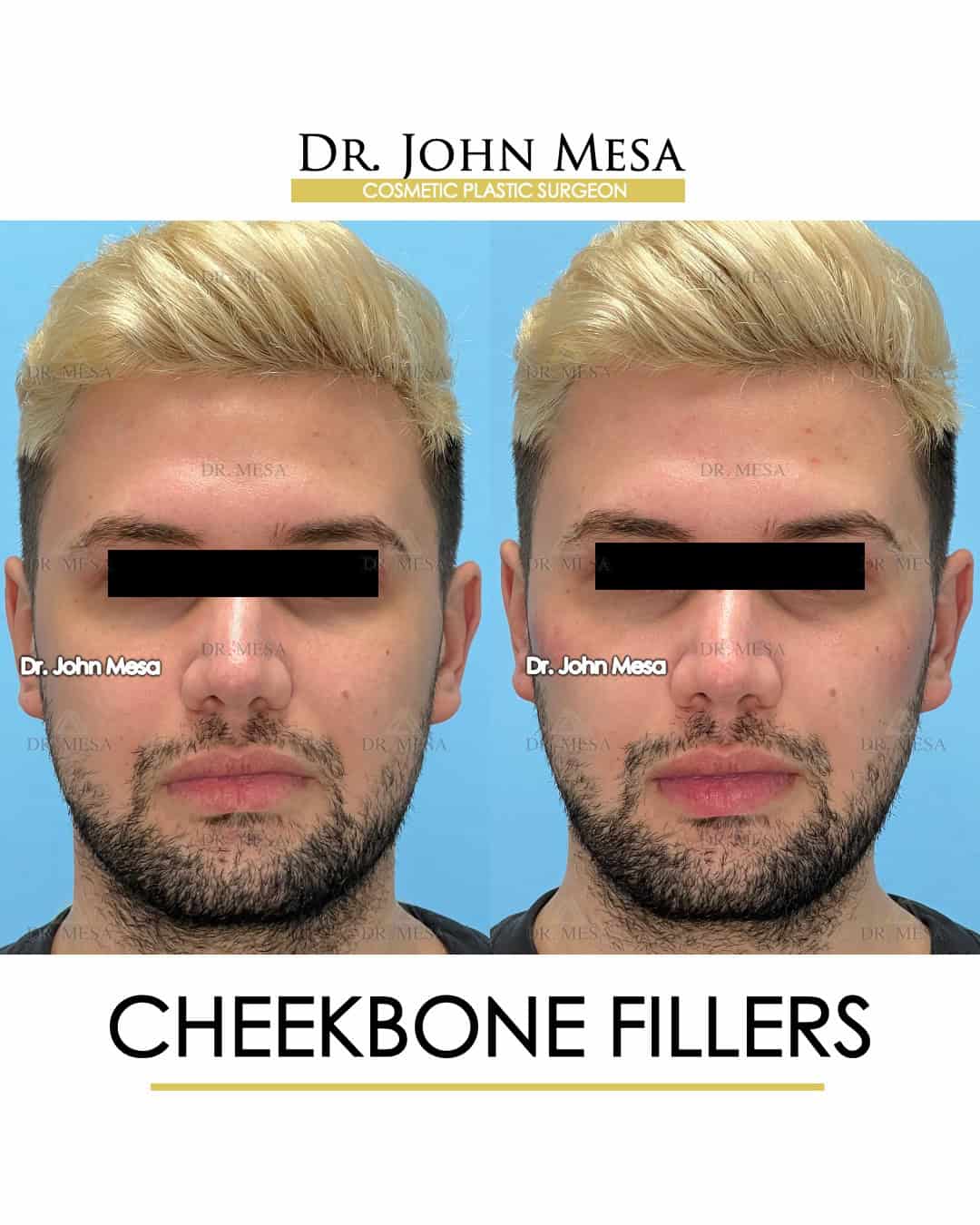 cheekbone fillers surgery
