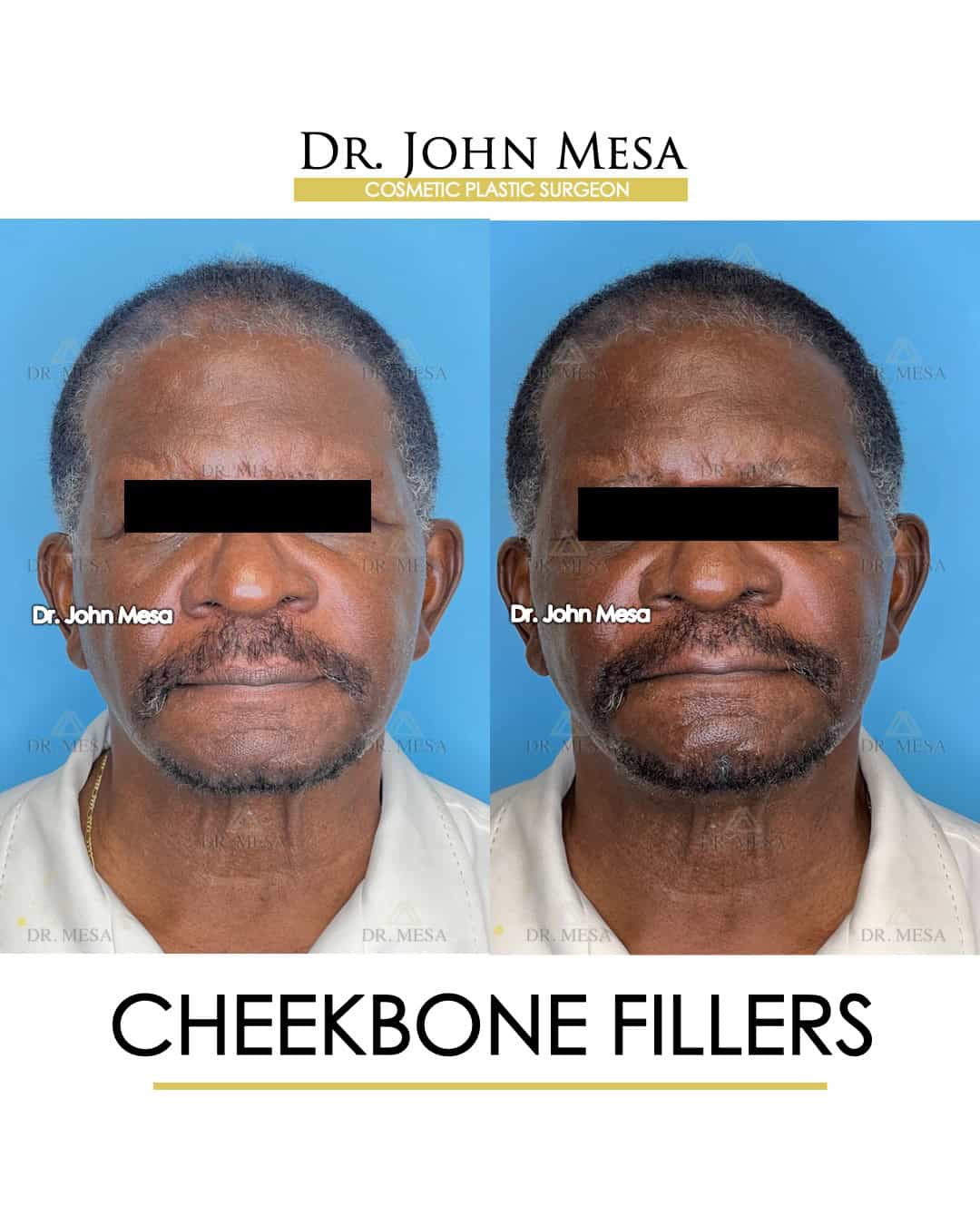 cheekbone fillers surgery doctor