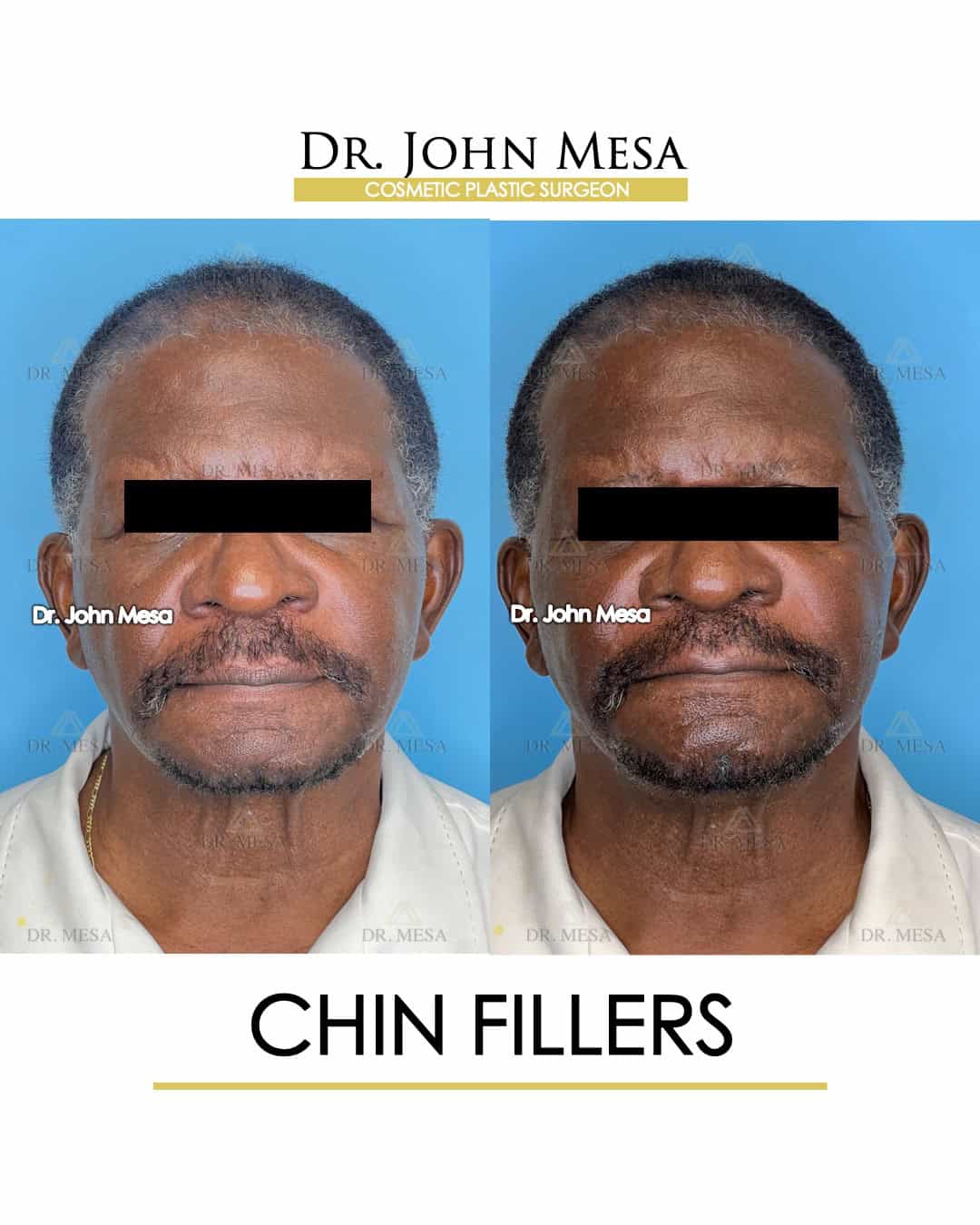 men chin fillers before and after transformation
